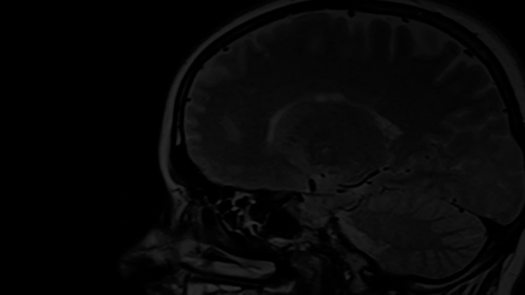 Brain Injury Attorney